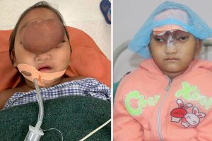 नोबेलले निःशुल्क अप्रेशन गर्दा फेरियो ५ बर्षे उमिसाको अनुहार