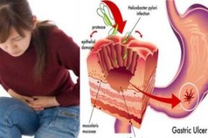 ग्यास्ट्रिकका रोगीले के गर्ने, के नगर्ने ? जन्नुहोस अनि शेयर गर्नुहोस…