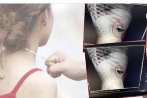 इटहरीकाे हवाइचाेकमा दिउसै लुटियाे सुनकाे सिक्रि , गाेजी छाम्दा नभेटिएकाे सुन पेटमा देखिएपछि अस्पताल राखेर निग्रानी