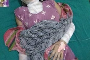 एसिड आक्रमणः कलिलो उमेरको आर्कषण, प्रेम र अस्विकार
